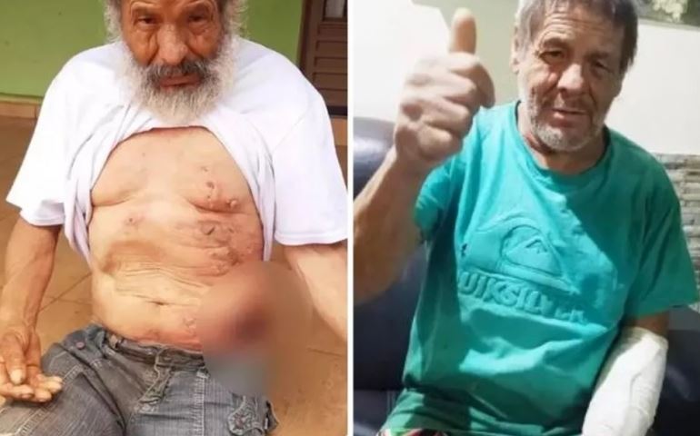 Morador de rua que foi queimado em praça recebe alta e é acolhido por lar de idosos em Buri