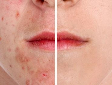 ACNE: TUDO O QUE VOCÊ PRECISA SABER